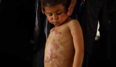 Gazze’de Yanık Hastaları İçin Tıbbi Malzeme Krizi: MSF’den Acil Yardım Çağrısı