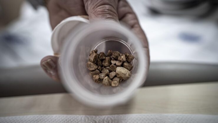 İstanbul’dan Erzurum’a Şifa Yolculuğu: 2 Çocuk Annesinden 51 Taş Çıktı!