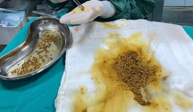Bingöl’de Nadir Görülen Vaka: Safra Kesesinden 2067 Taş Çıkarıldı