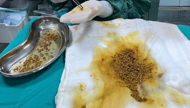 Bingöl’de Nadir Görülen Vaka: Safra Kesesinden 2067 Taş Çıkarıldı